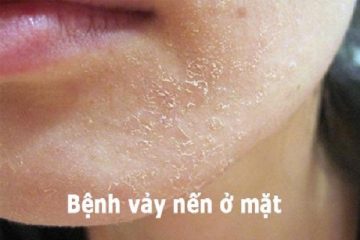 Bị vảy nến ở da mặt có ảnh hưởng không và thuốc trị tận gốc