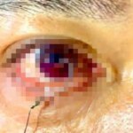 1780584476 Cap cuu benh nhan bi luoi cau ghim vao mat