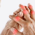 Cách Chữa Bệnh Gút Giai Đoạn Đầu
