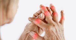 Cách Chữa Bệnh Gút Giai Đoạn Đầu
