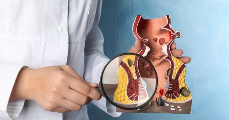 Cách Chữa Bệnh Trĩ Bằng Thuốc Tây Y