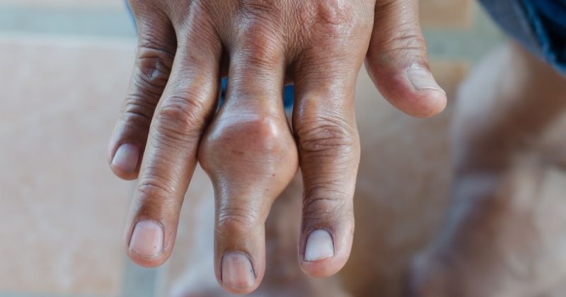 Điều Chỉnh Thói Quen Sinh Hoạt Để Ngăn Ngừa Bệnh Gút Tiến Triển
