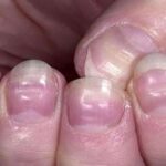 Móng Tay Bị Lõm Là Bệnh Gì? Nguyên Nhân Và Cách Xử Lý