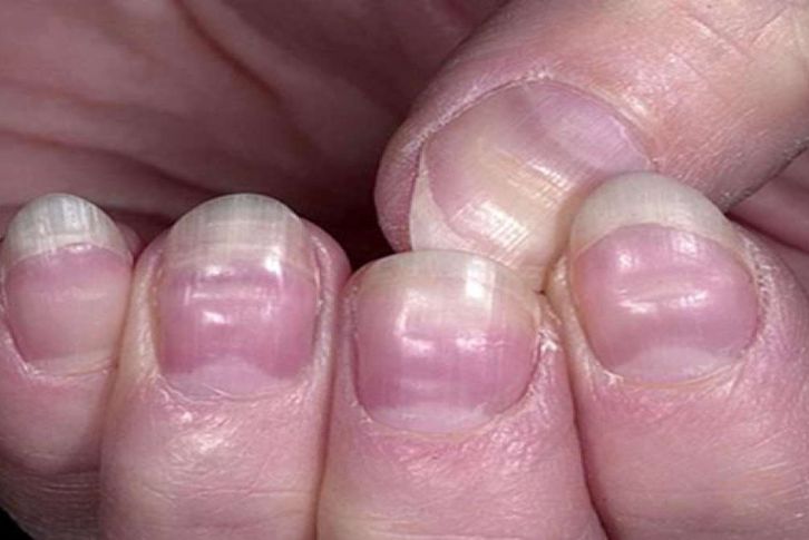 Móng Tay Bị Lõm Là Bệnh Gì? Nguyên Nhân Và Cách Xử Lý